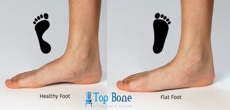 علاج الفلات فوت: الحلول الطبية والجراحية الفعالة