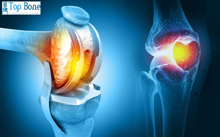 تكلفة عملية استبدال مفصل الركبة 2025